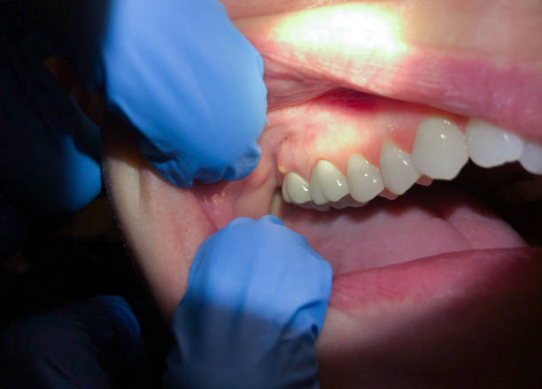 Best Emergency Dental Care for Abscessed Tooth in Seville, FL